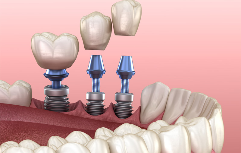 Billion-Dollar Bones: The Explosive Growth of PEEK Implants Explained