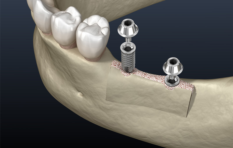 Revolutionizing Dental Implants: How Deep Learning is Transforming 3D Bone Segmentation and Tooth Prediction