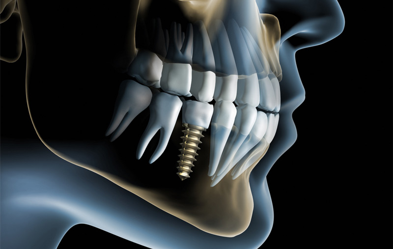 Revolutionizing Smiles: The Cutting-Edge Features of New Dental Implant Materials and Design