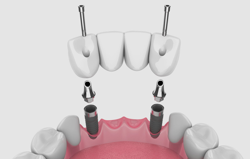 Prevent dental issues with multiple tooth implants at Fusion Dental Implant Club at Roseville, CA