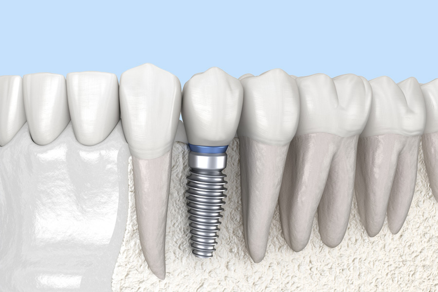 Single tooth replacement with dental implant and crown at Fusion Dental Implant Club at Roseville, CA