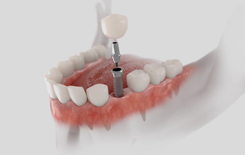 Single tooth replacement with dental implant and crown at Fusion Dental Implant Club at Roseville, CA