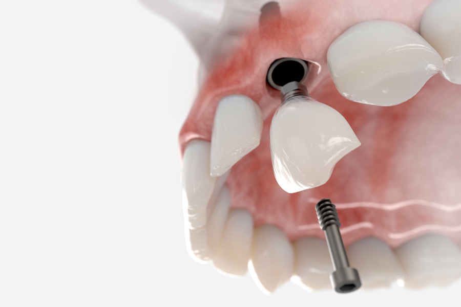 Single tooth replacement with dental implant and crown at Fusion Dental Implant Club at Roseville, CA