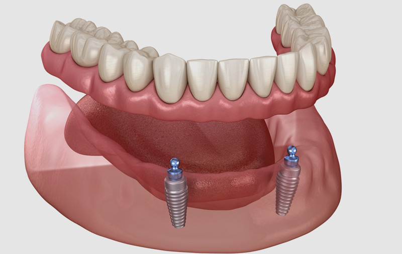 Tired of the common problems with traditional dentures? Try Snap-On dentures at Fusion Dental Implant Club at Roseville, CA