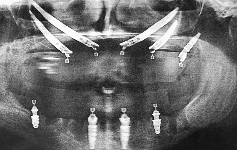 Zygomatic dental implants: s solution for those with jawbone loss at Fusion Dental Implant Club at Roseville, CA