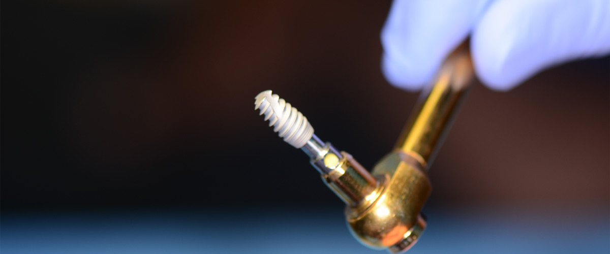 Quality Dental Implants at Fusion Dental Implant Club at Roseville, CA